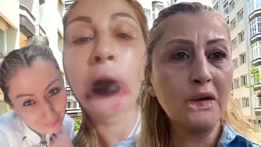 Estetik Dolgu Kabusu: Dudağı Çürüyen Kadın Adalet Arıyor