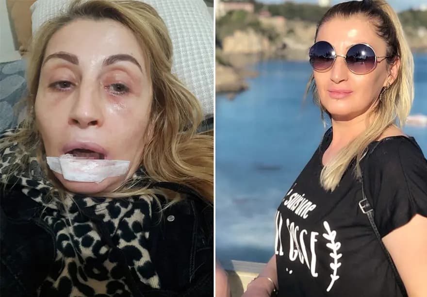 Estetik Dolgu Kabusu: Dudağı Çürüyen Kadın Adalet Arıyor — görsel 2