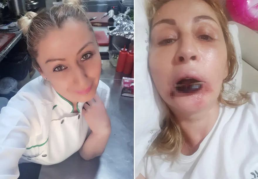 Estetik Dolgu Kabusu: Dudağı Çürüyen Kadın Adalet Arıyor — görsel 3