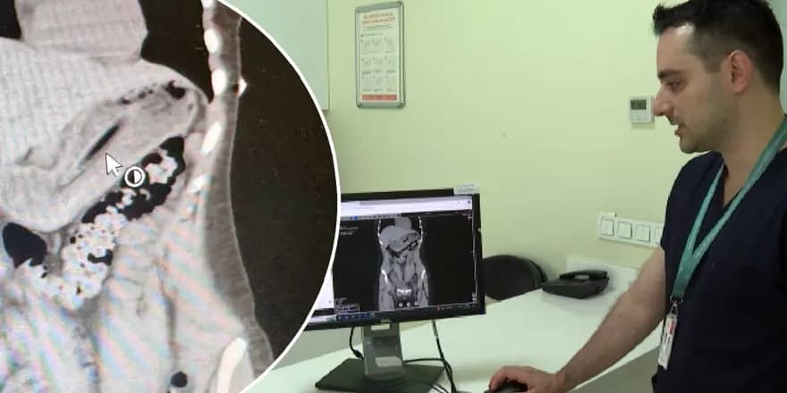 Zayıflama Hırsı Başına Dert Açtı: Diş Fırçası Yuttu!