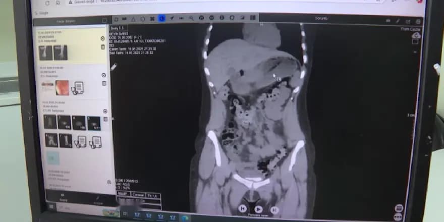 Zayıflama Hırsı Başına Dert Açtı: Diş Fırçası Yuttu! — görsel 3