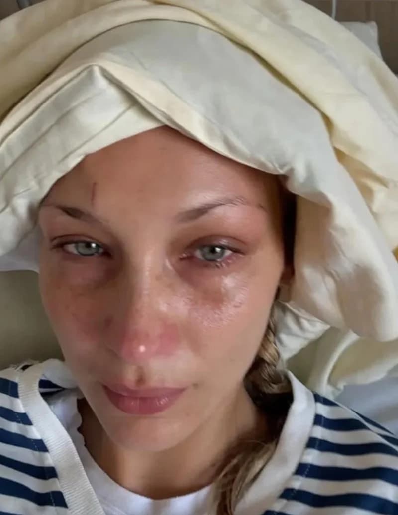 Bella Hadid, Lyme hastalığıyla mücadelesini duyurdu — görsel 2