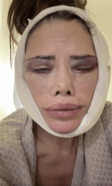 Didem Ceran, Yüz Nakli Sonrası Yeniden Ameliyat Oldu