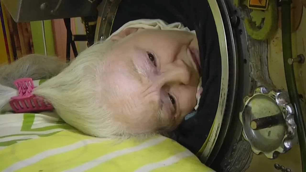 73 Yıl Demir Akciğerle Yaşadı, Sonunda Hayatını Kaybetti — görsel 3